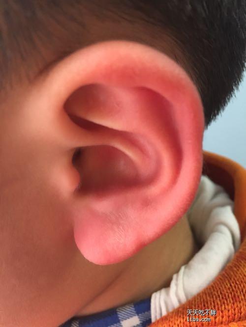 耳朵红热是什么原因的相关图片